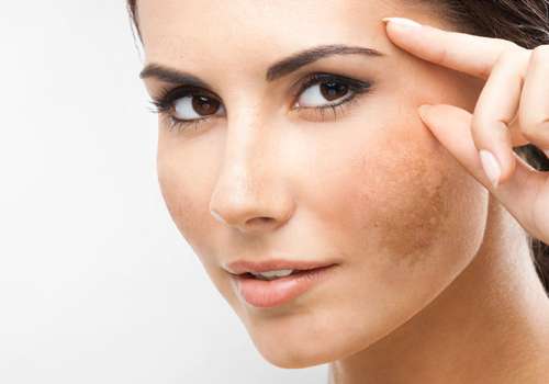 Sau liệu trình trị thâm nám, có những biện pháp chăm sóc hay gợi ý nào để duy trì hiệu quả của dịch vụ không?